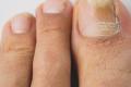 Чем лечить грибок ногтей на ногах в запущенной стадии Чем вылечить ногти на ногах от грибка
